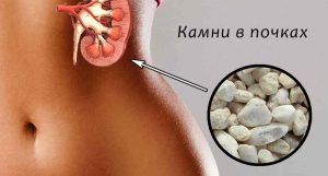Для лечения камней в почках, следует проконсультироваться с опытным урологом, чтобы он смог подобрать для вас оптимальную дозу препарата Для лечения камней в почках, следует проконсультироваться с опытным урологом, чтобы он смог подобрать для вас оптимальную дозу препарата