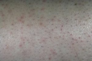 Опытный врач порекомендует использовать эту мазь для лечения острых нейродермитов различной этиологии Опытный врач порекомендует использовать эту мазь для лечения острых нейродермитов различной этиологии