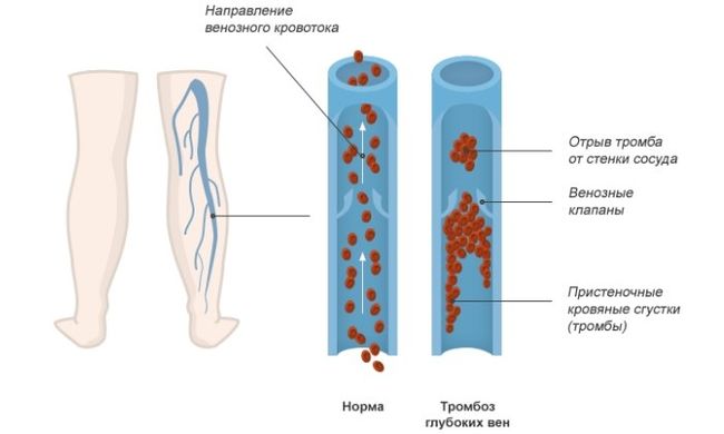 Развитие тромбоза глубоких вен нижних конечностей