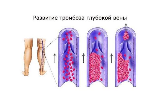 Тромбоз глубоких вен нижних конечностей может возникнуть из-за изменения сворачиваемости и густоты крови