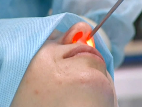 Одиночные новообразования удаляют с помощью лазера, это наименее травматичный метод удаления полипов в носу