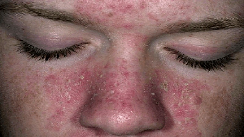 На фото показано как выглядит запущенный Атопический дерматит на лице девушки.