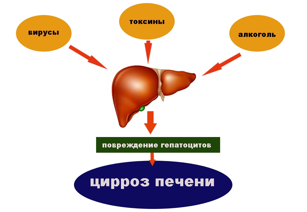 Признаки цирроза печени симптомы у женщин после 40 лет фото