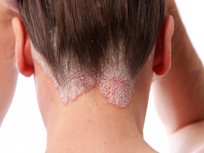 Псориаз - кожное заболевание хронического типа, проявляется высыпаниями и шелушениями на коже