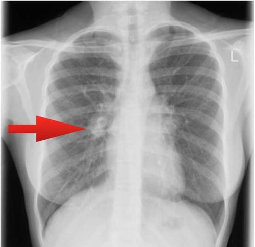 Так выглядит туберкулез на рентгеновском снимке 