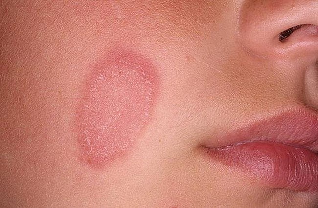 Шелушение на лице может свидетельствовать о грибковом поражении кожи
