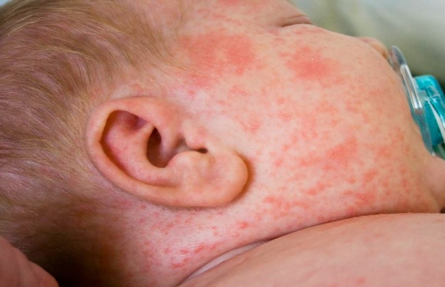 Виферон может вызвать аллергическую реакцию у ребенка