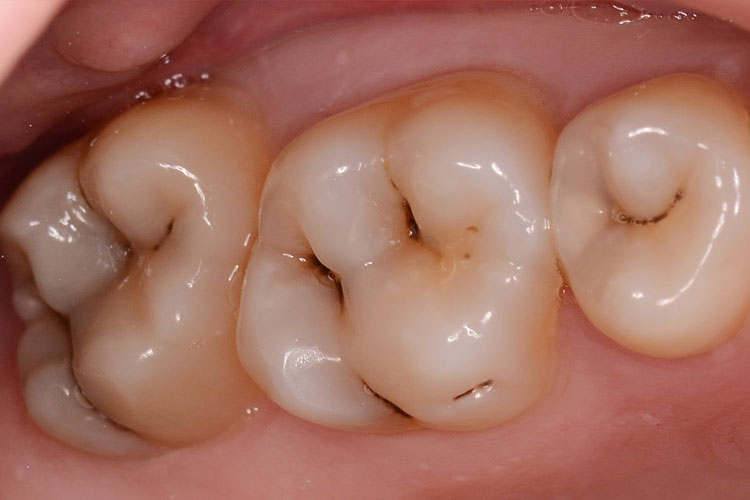 Кариес – это постепенное разрушение твердых тканей зуба — эмали и дентина