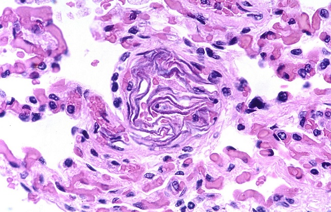 Изображение представляет собой гистологический слайд эмболии амниотической жидкости, вызванный наличием клеток плода в одном из легочных артериол матери.