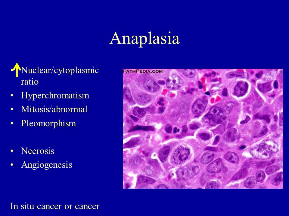 Neoplasia es igual a cancer