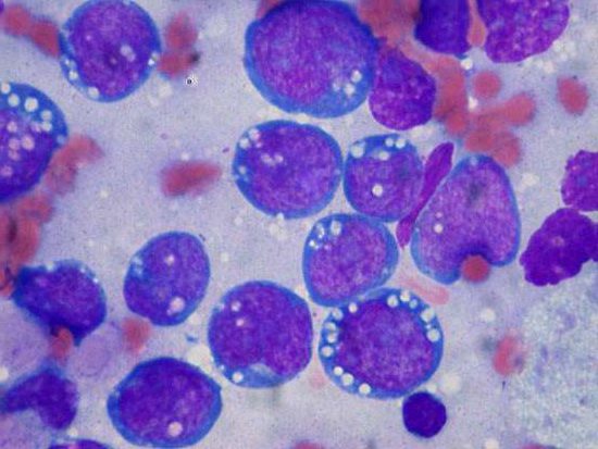 Лимфома буркитта. Клетки лимфомы Буркитта в препарате касания, типе клетк-основанного диагностического метода.