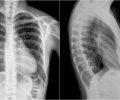 Рентген грудной клетки: сердце, легкие, кости