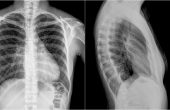 Рентген грудной клетки: сердце, легкие, кости