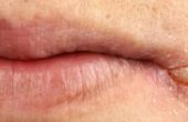 Ангулярный стоматит: о чем говорят болячки в уголках рта?