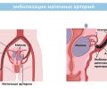 Эмболизация маточных артерий при миоме матки: особенности проведения, показания и противопоказания