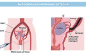 Эмболизация маточных артерий при миоме матки: особенности проведения, показания и противопоказания