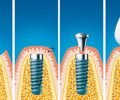 Процедура имплантации зуба: все, что вам нужно знать