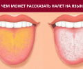Желтый налет на языке: что это значит и когда стоит обратиться к врачу