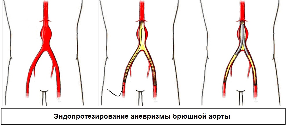 Диагностика аневризмы брюшной аорты симптомы. Аневризма подвздошной артерии. Операция Дэвида аневризма восходящей аорты. Аневризма брюшной аорты операция. Аневризма брюшной артерии.