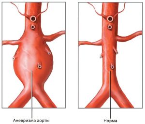 Аневризма аорты - это патологическое расширение стенки аорты в брюшном отделе
