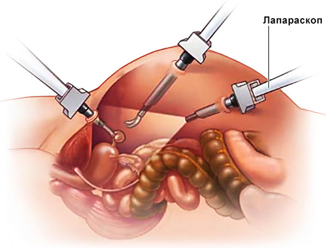 Лапароскопия – при этой операции в животе делают небольшие отверстия, через которые вводят инструменты