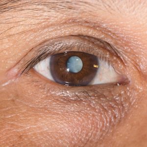 Метод лечения зависит от того, на что конкретно оно направлено: на остановку прогрессии болезни или на полное восстановление зрения