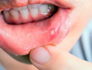 Афтозный стоматит проявляется в виде язвочок, которые можно увидеть на губах