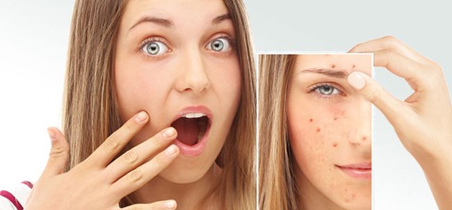Акне кожи лица - это закупорка и последующее воспаление волосяных луковиц