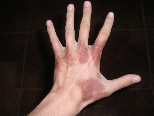 При нарушении обмена порфириновых соединений, после взаимодействия ультрафиолета с кожей, он вызывает аллергическую реакцию