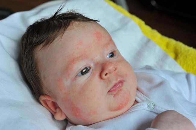 Дети со светлой кожей и с веснушками, чаще подвержены аллергии на солнце