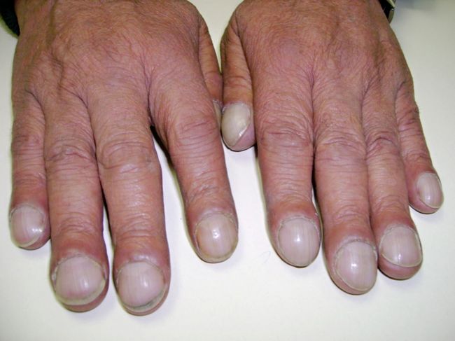Утолщение фаланг пальцев и изменением формы ногтей в виде часовых стекол - один из симптомов заболевания