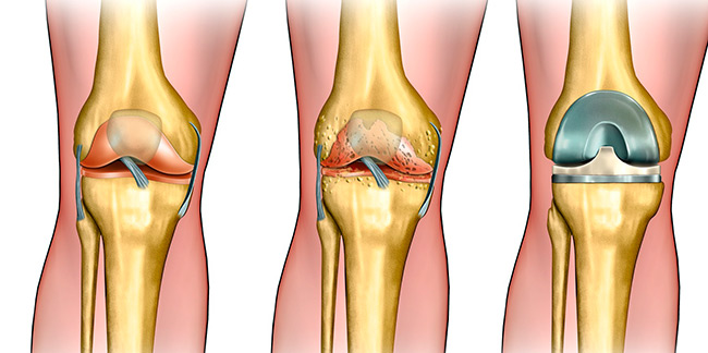Первая степень артроза характеризуется несильными болями при длительном нахождении ноги в одном положении, которые после отдыха проходят