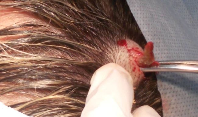 Фото удаления атеромы из головы пациента. Фото кликабельно.