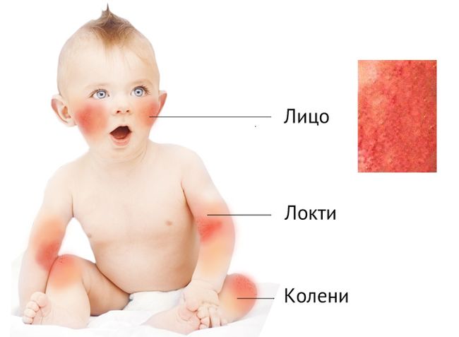 У грудного ребенка элементы атопического дерматита локализуются преимущественно на лице, туловище, на изгибах локтей и коленей, в области подмышек, лба и затылка