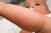 Ребенок страдает от атопического дерматита? Узнайте о симптомах и лечении болезни