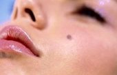 Базалиома кожи лица – симптомы, диагностика и лечение заболевания