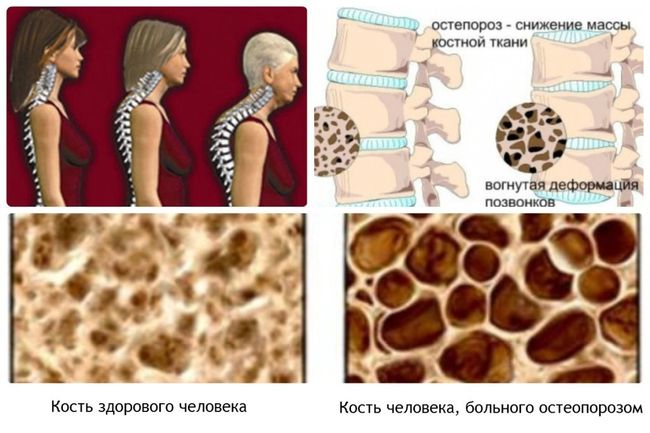 При остеопорозе снижается масса костной ткани