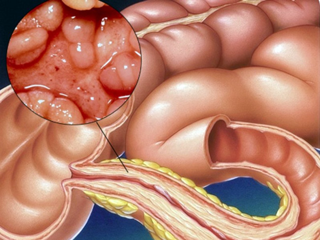 Болезнь Крона – это хроническое заболевание желудочно-кишечного тракта, которое может поразить любой отдел пищеварительной системы, чаще всего конечный отдел тонкой и/или толстую кишку