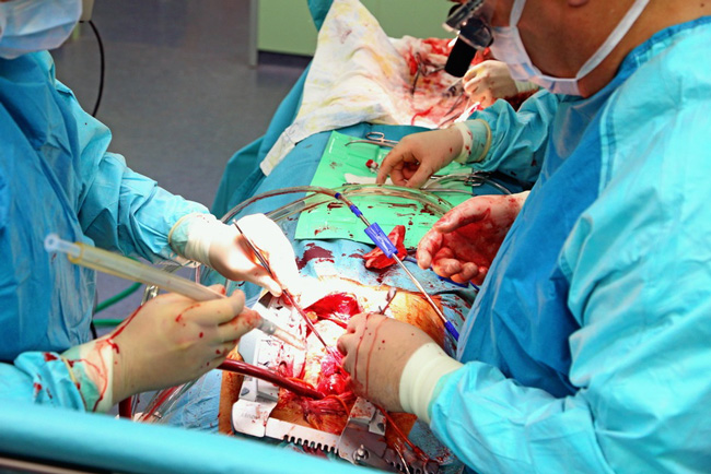 Аортокоронарное шунтирование (АКШ) – это операция, суть которой заключается в создании обходных путей, минуя пораженные атеросклерозом коронарные артерии сердца