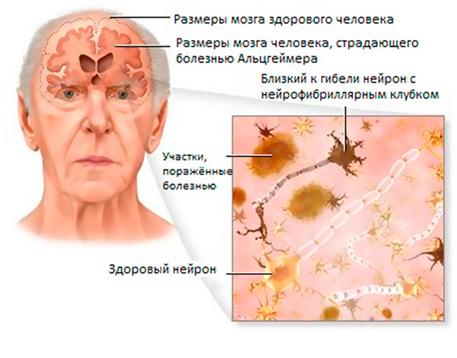 Деменция – одно из тяжелейших видов расстройств работы нервной системы, связанное с органическим поражением мозга