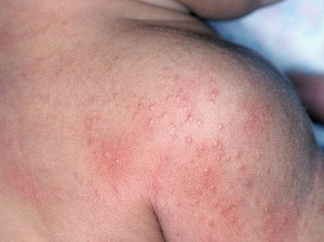 Контактный дерматит имеет схожую клиническую картину с аллергическим типом дерматита