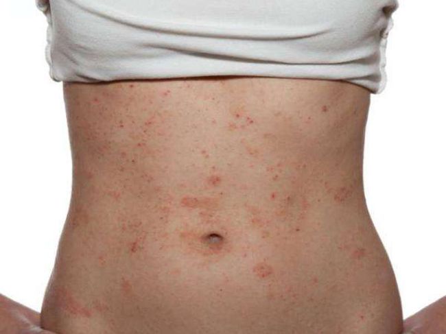 Атопический дерматит у взрослых возникает при неправильно подобранном лечении аллергического воспаления кожи