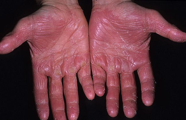 Экзема на руках – это хронический воспалительный процесс верхних слоев эпителия, имеющий нервно-аллергическую природу, что говорит о том, что болезнь не заразна для окружающих людей