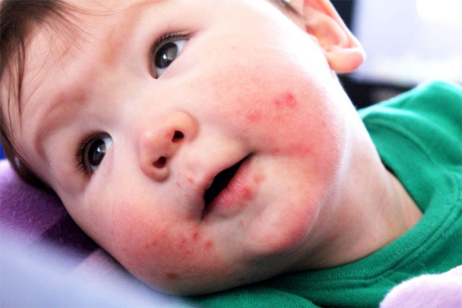 Энтеровирусным инфекциям, чаще подвержены дети в возрасте от 3 до 10 лет из-за несформированности иммунитета