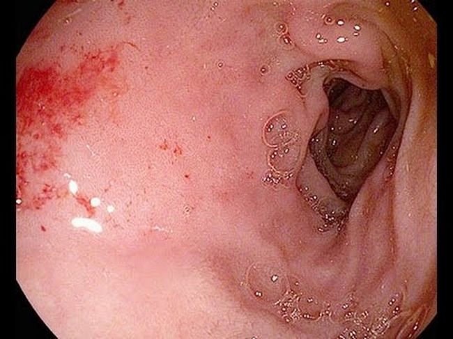 Гипертрофическая форма характеризуется появлением точечных кровоизлияний и увеличении слизистого налета на эпителии кишки