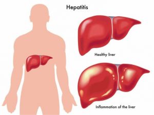 Гепатит А - причина воспаления печени