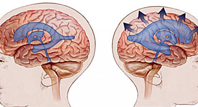 Головной мозг, слева в норме, справа при Гидроцефалии