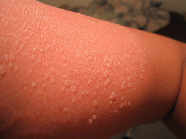 Появление на месте ожога волдырей является симптомом серьезного повреждения кожи