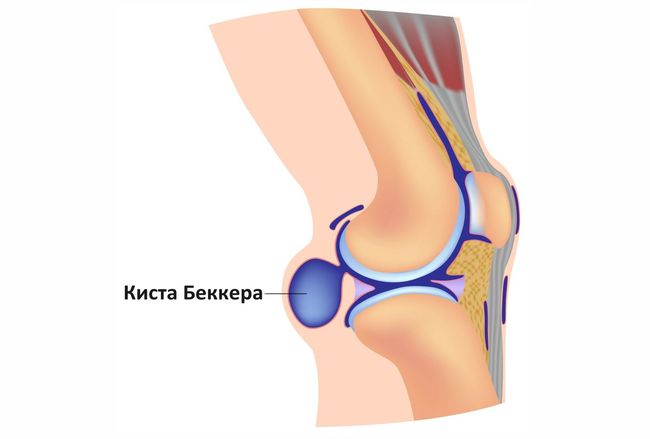 Киста Беккера под коленом - это патология, причиняющая большой дискомфорт