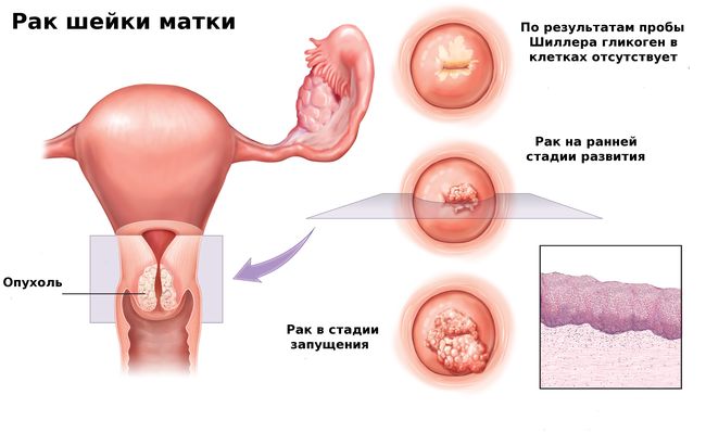На фото показан рак шейки матки.